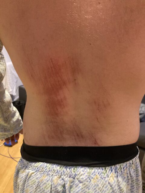Alex's back shows how he was dragged along the floor by the police dog. 